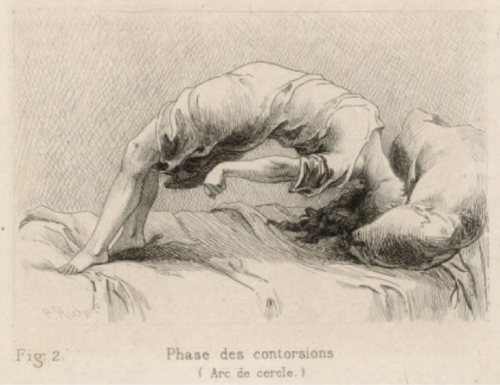 Desen de Charcot, ilustrând o criză de isterie